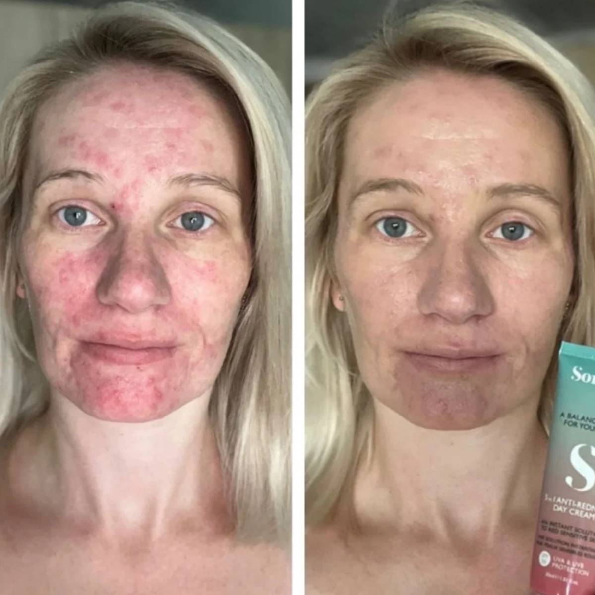 Sorted Skin 5 in 1 Anti - Redness Day Cream SPF50 - Bodylux